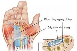 Đứt dây thần kinh giữa