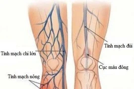 Biến chứng tắc mạch hậu COVID-19