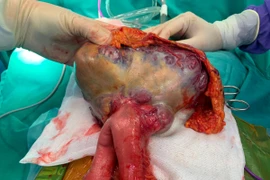 Cắt khối u GIST ruột non chiếm hết ½ dưới ổ bụng