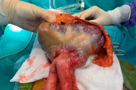 Cắt khối u GIST ruột non chiếm hết ½ dưới ổ bụng