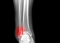 Liệt vì đắp lá khi bị vỡ xương chày 