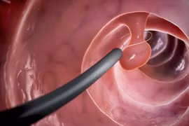 Polyp đại tràng khi nào cần cắt bỏ?