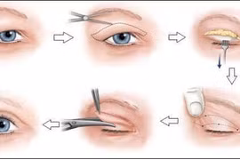 Xử lý sụp mi mắt ở người già