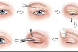 Xử lý sụp mi mắt ở người già