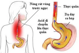  Đau lâm râm từ bụng có phải trào ngược?