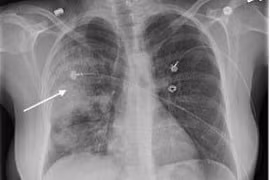 Tổn thương trên da… báo hiệu bệnh phổi