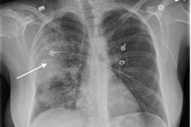 Tổn thương trên da… báo hiệu bệnh phổi