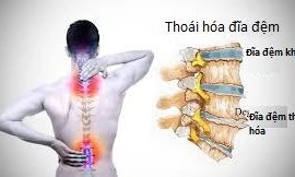 Nguyên nhân gây đau do thoái hóa đĩa đệm cột sống
