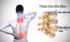 Nguyên nhân gây đau do thoái hóa đĩa đệm cột sống