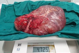 Mổ lấy thai và cắt khối u nhầy buồng trứng nặng 4,7kg