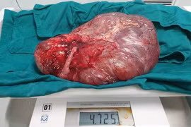 Mổ lấy thai và cắt khối u nhầy buồng trứng nặng 4,7kg