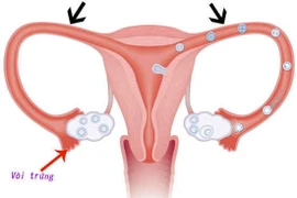 Tắc ống dẫn trứng, tinh trùng yếu có thể có con