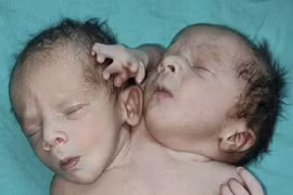 Ấn Độ: Trẻ sinh ra có hai đầu 