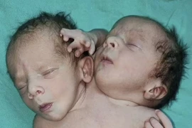 Ấn Độ: Trẻ sinh ra có hai đầu 