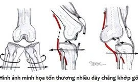 Tổn thương lại dây chằng chéo
