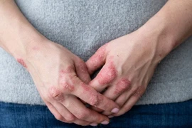Bệnh vảy nến: Nguyên nhân và cách cải thiện tại nhà