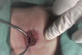 Lưỡi cưa mài bị gãy, cắt đứt khí quản bé trai 8 tuổi