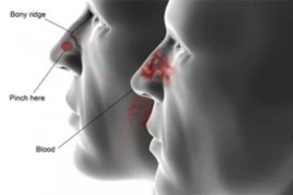 U xơ vòm mũi họng ở nam giới trẻ tuổi: Lành tính nhưng... dễ tử vong