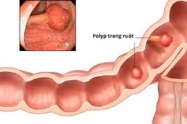 Khoảng 5-6% dân số có polyp đại tràng