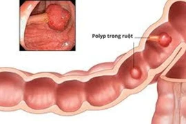Khoảng 5-6% dân số có polyp đại tràng