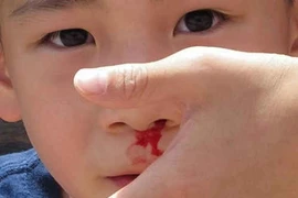 U xơ vòm mũi họng chảy máu dễ mất mạng