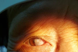  Suýt hỏng mắt vì chủ quan với mộng