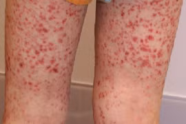 Viêm mao mạch dị ứng 