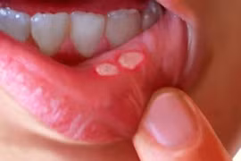 Ăn mặn loét miệng