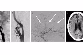 Chóng mặt do hẹp động mạch cảnh dễ tai biến