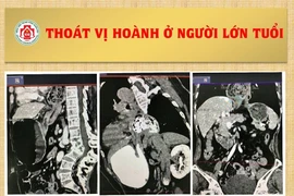 78 tuổi bị thoát vị dạ dày vào khoang lồng ngực