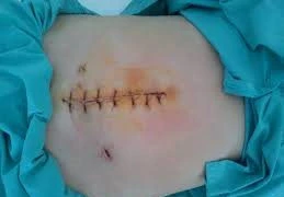 Rò và viêm dạ dày sau phẫu thuật