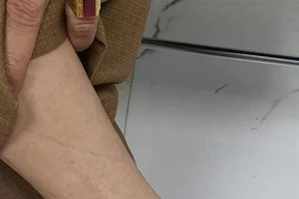 Chữa gút theo quảng cáo trên mạng, bệnh nặng thêm 