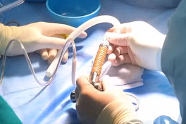 Vinmec cấy ghép thành công tim nhân tạo hỗ trợ tâm thất cho bệnh nhân suy tim giai đoạn cuối