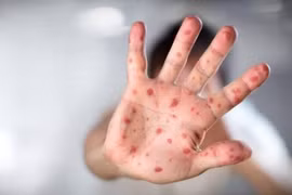 Triệu chứng bệnh tay chân miệng ở trẻ và cách cải thiện tại nhà