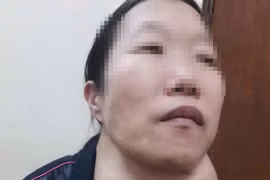 Mổ thành công bệnh nhân u tuyến giáp khổng lồ gây chít hẹp khí quản