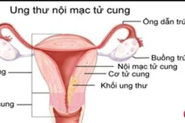 Ra máu bất thường ngoài kỳ kinh 