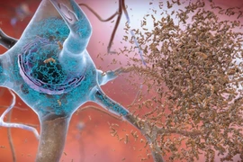 Phương pháp mới chế tạo văcxin và điều trị bệnh Alzheimer