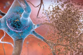 Phương pháp mới chế tạo văcxin và điều trị bệnh Alzheimer