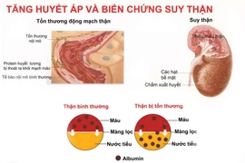 Các yếu tố khiến bệnh thận gây tăng huyết áp