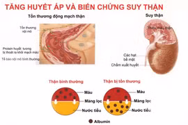 Các yếu tố khiến bệnh thận gây tăng huyết áp