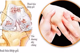 6 biện pháp phòng, chữa đau cơ xương khớp trời lạnh