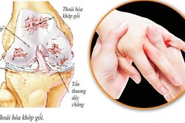 6 biện pháp phòng, chữa đau cơ xương khớp trời lạnh