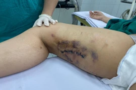 Nhiễm trùng, hoại tử da vì chích thuốc tan mỡ 