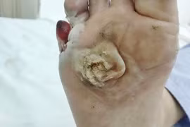 Bỏng nặng vì câu cá gần đường dây điện cao thế