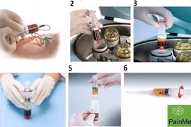 Huyết tương giàu tiểu cầu điều trị thoái hóa khớp gối