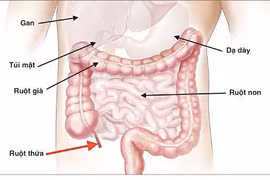  Ca đau ruột thừa không có triệu chứng 