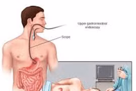 Xuất huyết tiêu hóa do vỡ tĩnh mạch thực quản