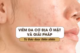Viêm da cơ địa ở mặt và giải pháp từ thảo dược thiên nhiên