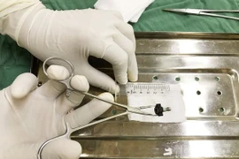 Dị vật được phẫu thuật lấy ra từ âm đạo của bé gái 8 tuổi 