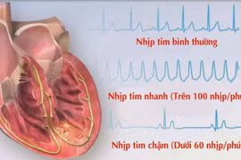 Nhịp tim xoang nhanh do mỡ máu